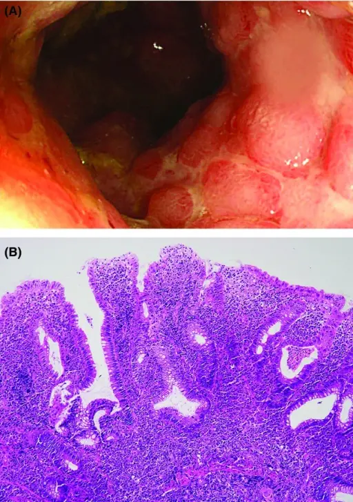 Ulcerative Colitis