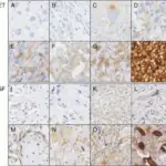 Undifferentiated Pleomorphic Sarcoma