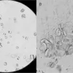 Urate Nephropathy