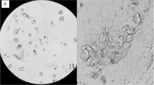 Urate Nephropathy