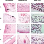 Ureaplasma Urealyticum