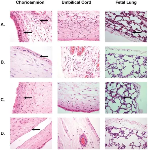 Ureaplasma Urealyticum