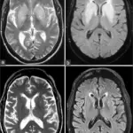 Uremic Neuropathy