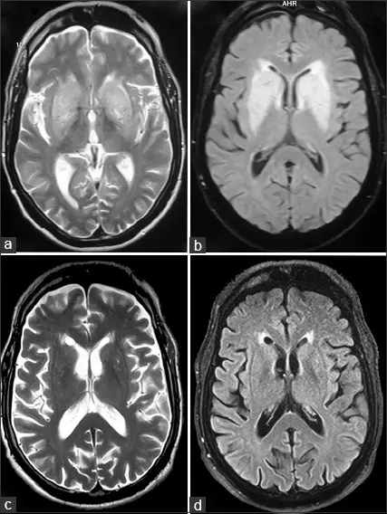 Uremic Neuropathy