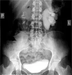 Ureteropelvic junction obstruction