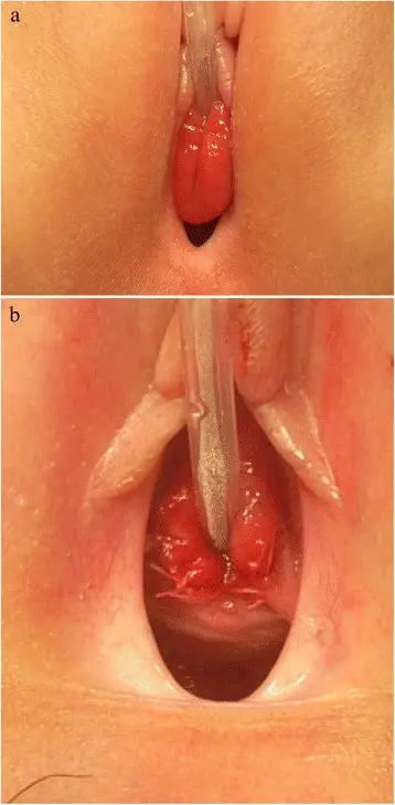 Urethral Caruncle