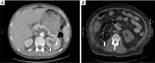 Urolithiasis