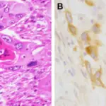 Urothelial Carcinoma of the Renal Pelvis