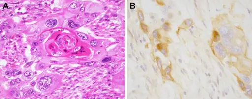 Urothelial Carcinoma of the Renal Pelvis