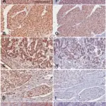 Urothelial Carcinomas