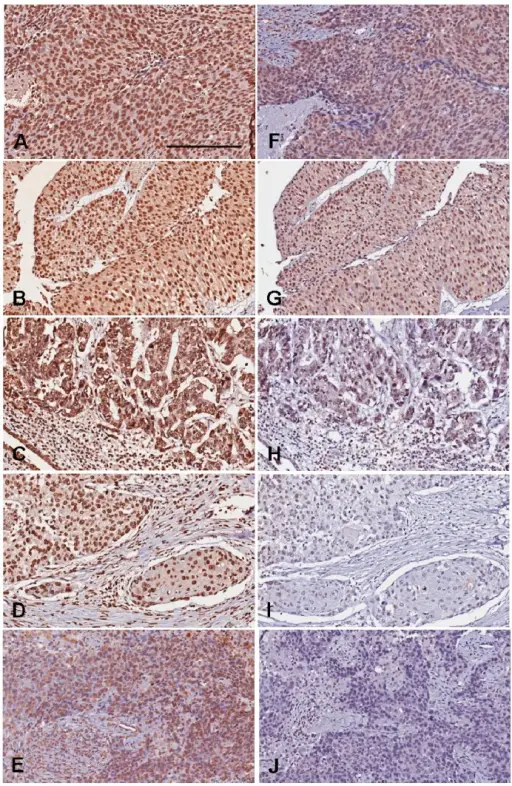 Urothelial Carcinomas