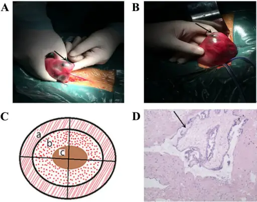 Uterus Pathology