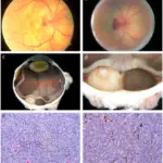 Uveal Melanomas