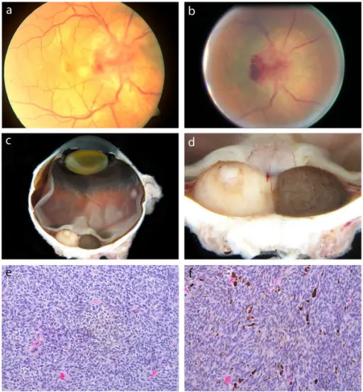 Uveal Melanomas