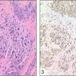 Uveal Neoplasms