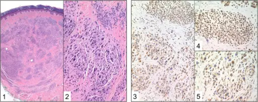 Uveal Neoplasms