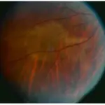 Uveitis