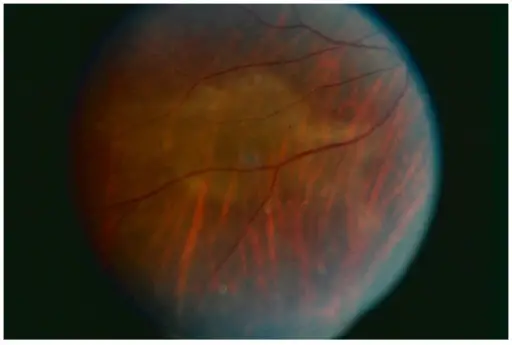 Uveitis