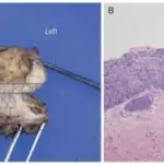 Vaginal Intraepithelial Neoplasia