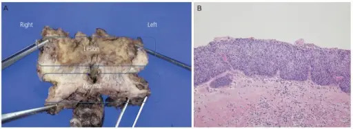 Vaginal Intraepithelial Neoplasia