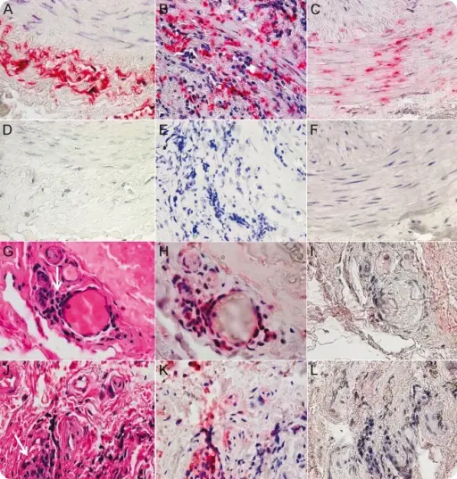 Varicella-Zoster Virus Infectious Neuropathy