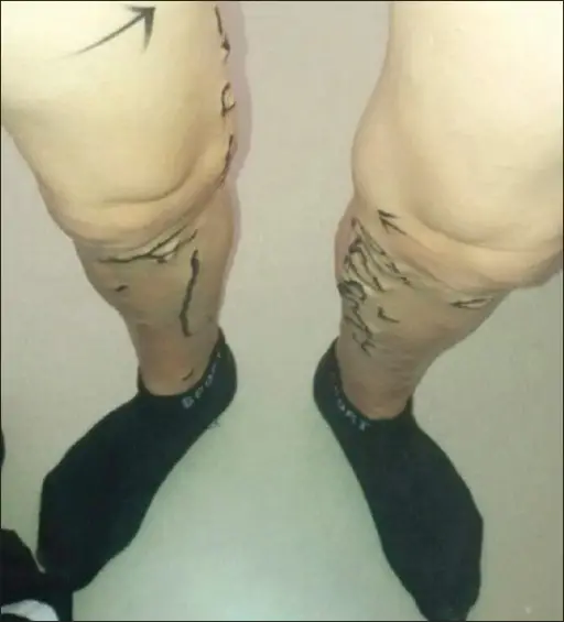 Varicose Veins