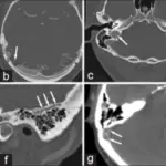 Vascular Anomalies