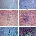 Vasculitis