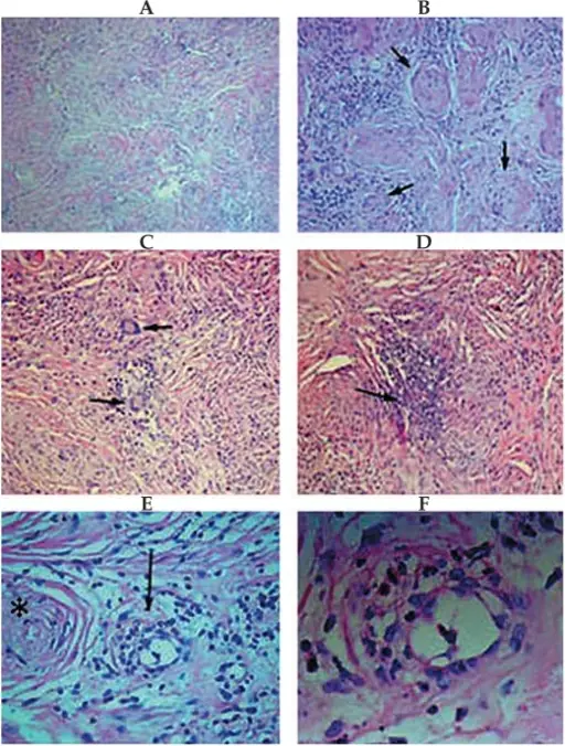 Vasculitis