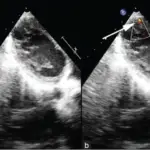 Ventricular Septal Defect