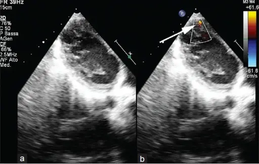 Ventricular Septal Defect