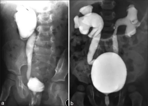 Vesicoureteral Reflux