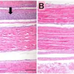 Viral Arthritis