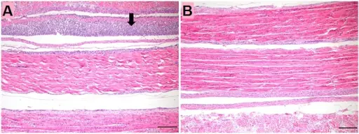 Viral Arthritis