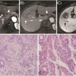 Viral Hepatitis