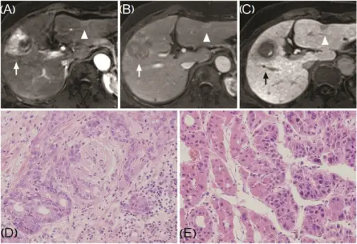 Viral Hepatitis