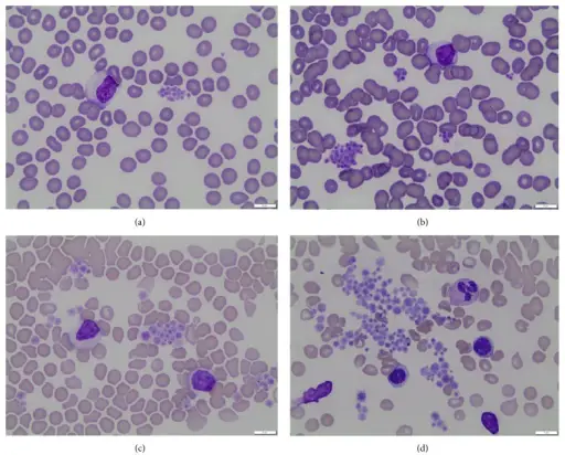 Von Willebrand Disease