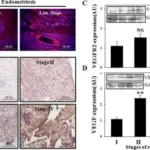 Von Willebrand Disease