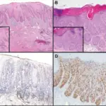 Vulvar Intraepithelial Neoplasia