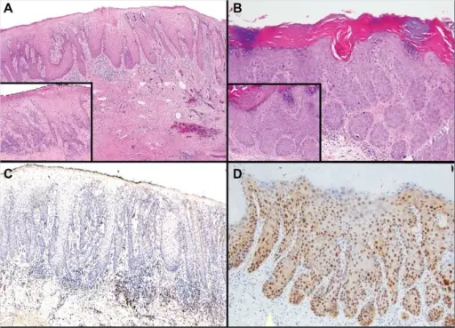 Vulvar Intraepithelial Neoplasia