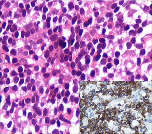 Waldenstrom Macroglobulinemia