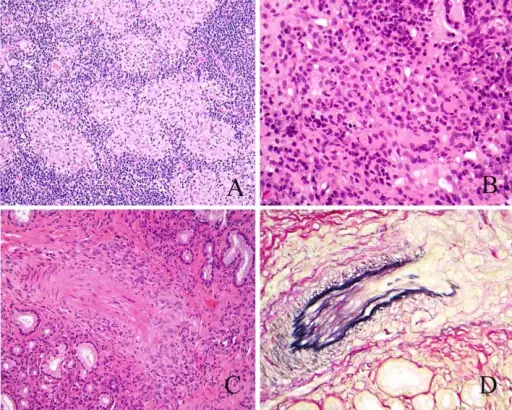 Wegener Granulomatosis