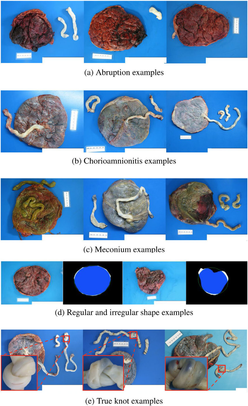 What Characterizes Placental Abnormalities