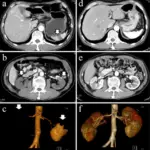 What Heart Diseases are Associated with Rheumatologic Disorders