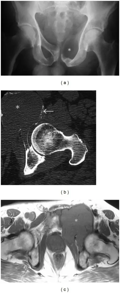 What Lesions are Similar to Primary Bone Neoplasms