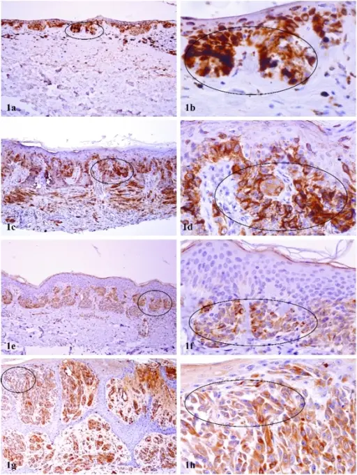 Wilms Tumor