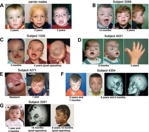 X linked disorders