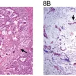 Yolk Sac Tumors