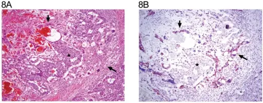 Yolk Sac Tumors