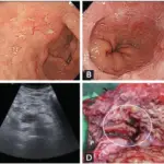 Zollinger-Ellison Syndrome